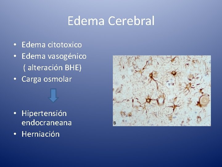 Edema Cerebral • Edema citotoxico • Edema vasogénico ( alteración BHE) • Carga osmolar