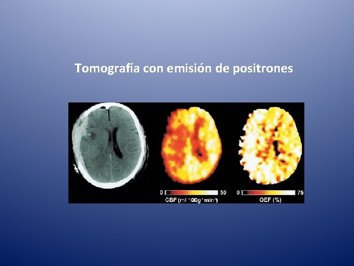 Tomografía con emisión de positrones 