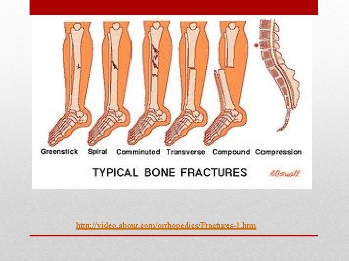 http: //video. about. com/orthopedics/Fractures-1. htm 