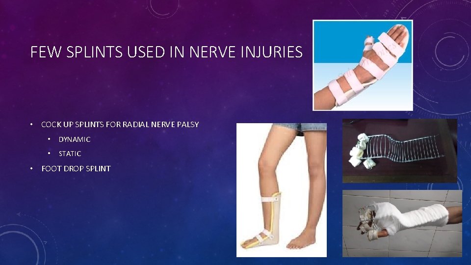 FEW SPLINTS USED IN NERVE INJURIES • COCK UP SPLINTS FOR RADIAL NERVE PALSY
