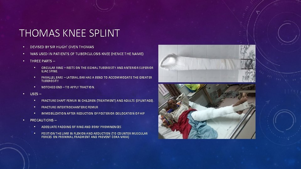 THOMAS KNEE SPLINT • DEVISED BY SIR HUGH’ OVEN THOMAS • WAS USED IN