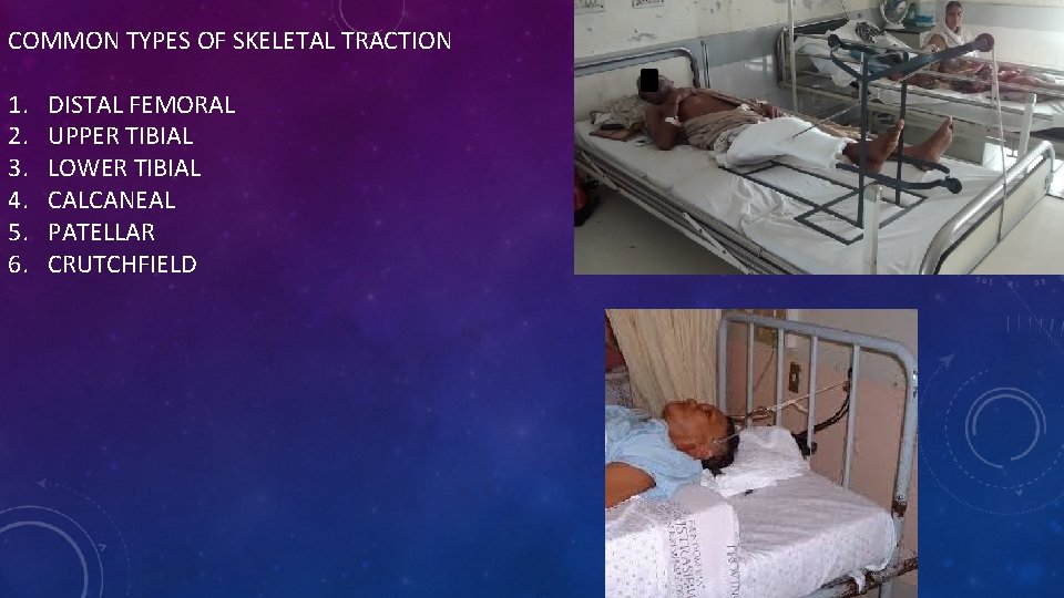 COMMON TYPES OF SKELETAL TRACTION 1. 2. 3. 4. 5. 6. DISTAL FEMORAL UPPER