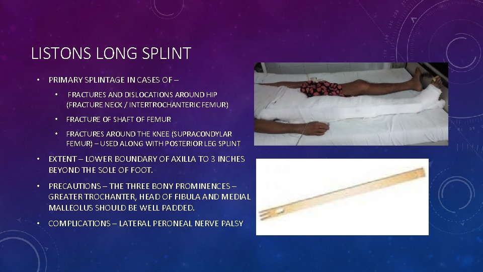 LISTONS LONG SPLINT • PRIMARY SPLINTAGE IN CASES OF – • FRACTURES AND DISLOCATIONS
