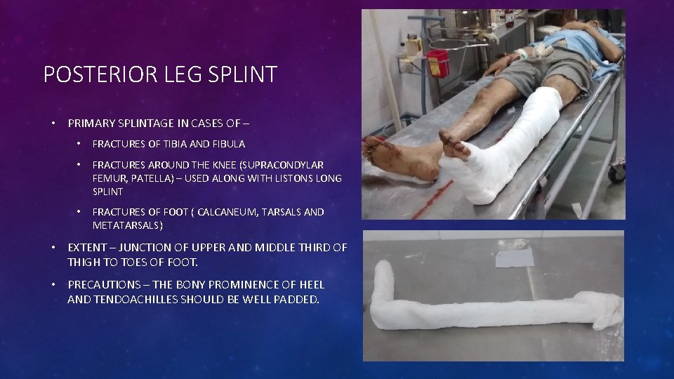 POSTERIOR LEG SPLINT • PRIMARY SPLINTAGE IN CASES OF – • FRACTURES OF TIBIA