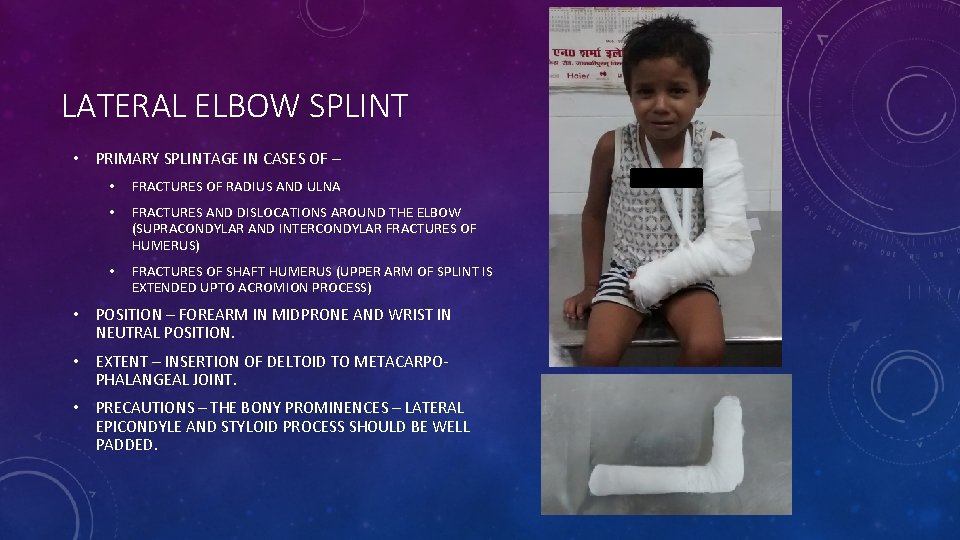 LATERAL ELBOW SPLINT • PRIMARY SPLINTAGE IN CASES OF – • FRACTURES OF RADIUS