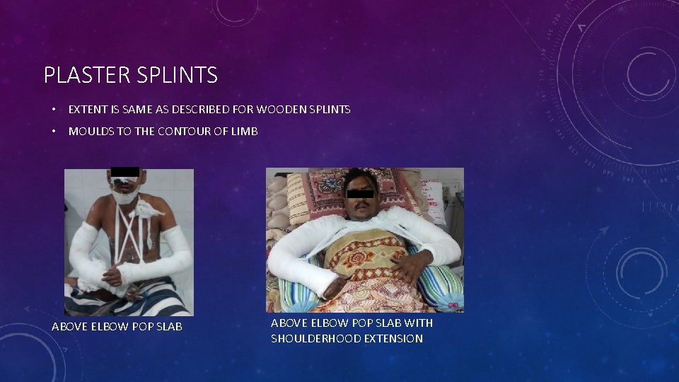 PLASTER SPLINTS • EXTENT IS SAME AS DESCRIBED FOR WOODEN SPLINTS • MOULDS TO