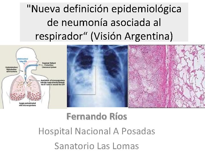 "Nueva definición epidemiológica de neumonía asociada al respirador“ (Visión Argentina) Fernando Ríos Hospital Nacional