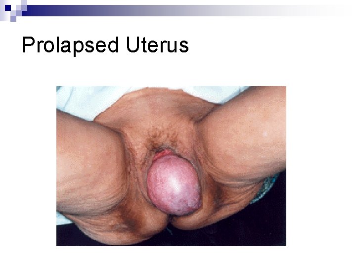 Prolapsed Uterus 