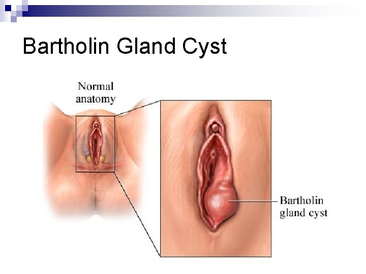 Bartholin Gland Cyst 