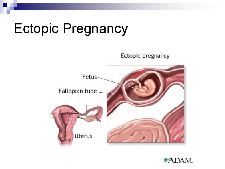 Ectopic Pregnancy 