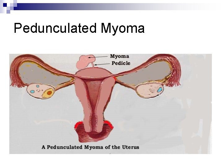 Pedunculated Myoma 