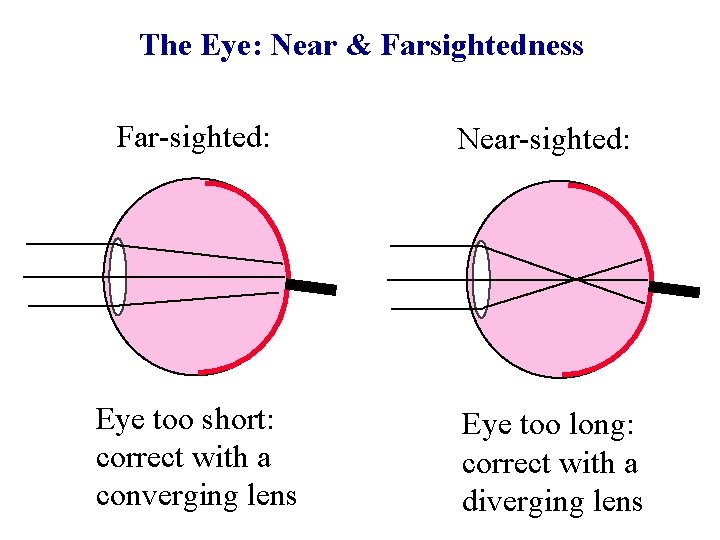 The Eye: Near & Farsightedness Far-sighted: Near-sighted: Eye too short: correct with a converging