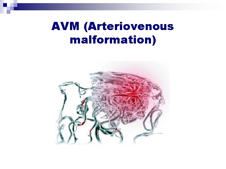 AVM (Arteriovenous malformation) AVM (Arteriovenous malformation)