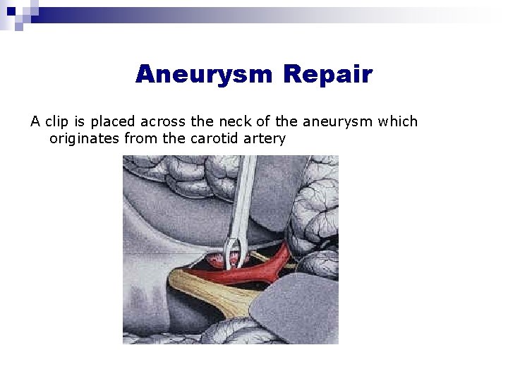 Aneurysm Repair A clip is placed across the neck of the aneurysm which originates Aneurysm Repair A clip is placed across the neck of the aneurysm which originates