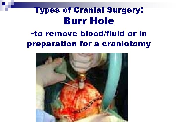 Types of Cranial Surgery: Burr Hole -to remove blood/fluid or in preparation for a Types of Cranial Surgery: Burr Hole -to remove blood/fluid or in preparation for a