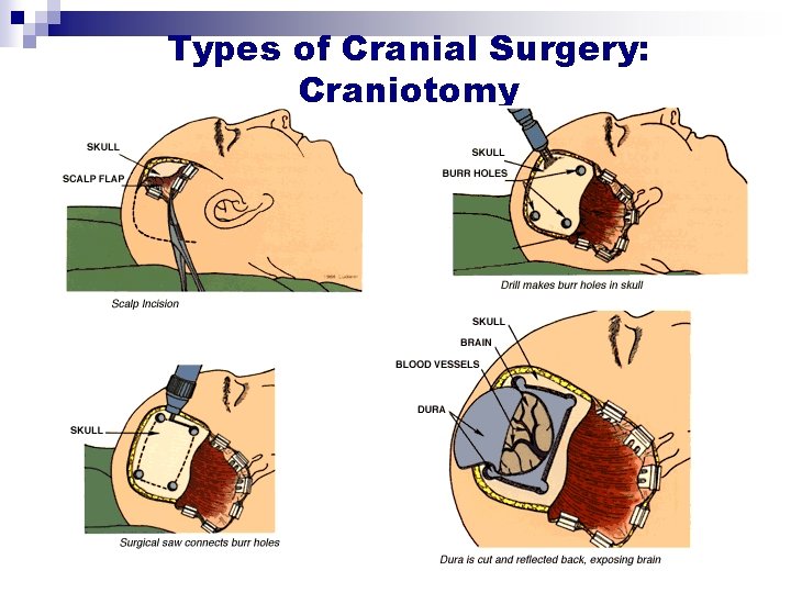 Types of Cranial Surgery: Craniotomy Types of Cranial Surgery: Craniotomy