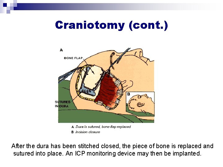 Craniotomy (cont. ) After the dura has been stitched closed, the piece of bone Craniotomy (cont. ) After the dura has been stitched closed, the piece of bone