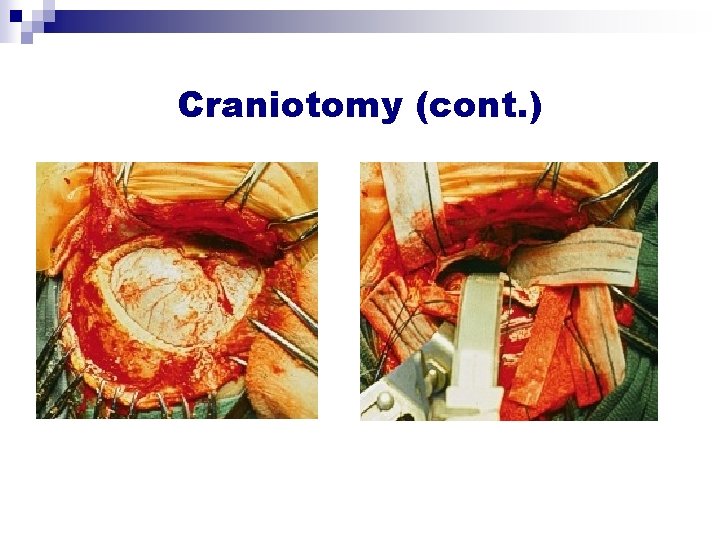 Craniotomy (cont. ) Craniotomy (cont. )