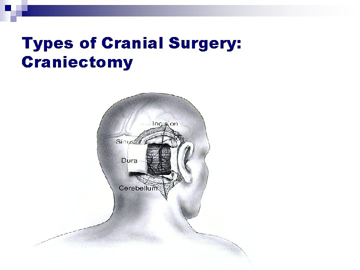 Types of Cranial Surgery: Craniectomy Types of Cranial Surgery: Craniectomy