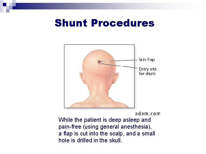 Shunt Procedures While the patient is deep asleep and pain-free (using general anesthesia), a Shunt Procedures While the patient is deep asleep and pain-free (using general anesthesia), a