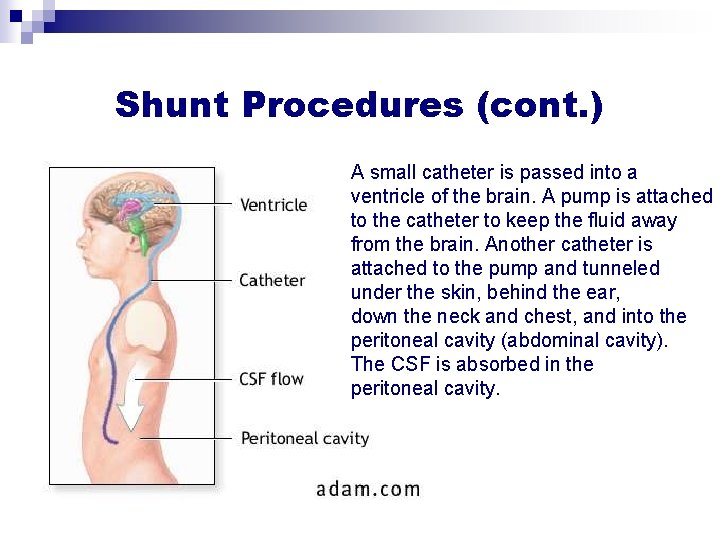 Shunt Procedures (cont. ) A small catheter is passed into a ventricle of the Shunt Procedures (cont. ) A small catheter is passed into a ventricle of the