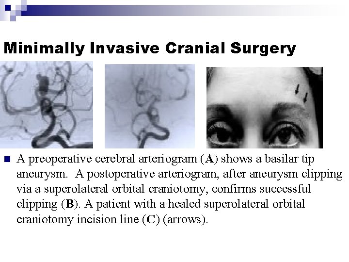 Minimally Invasive Cranial Surgery n A preoperative cerebral arteriogram (A) shows a basilar tip Minimally Invasive Cranial Surgery n A preoperative cerebral arteriogram (A) shows a basilar tip