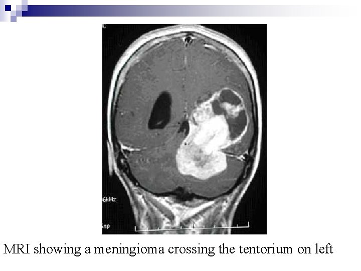 MRI showing a meningioma crossing the tentorium on left MRI showing a meningioma crossing the tentorium on left