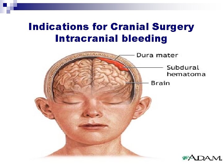 Indications for Cranial Surgery Intracranial bleeding Indications for Cranial Surgery Intracranial bleeding