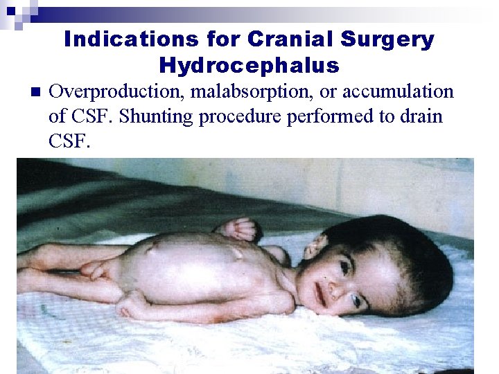Indications for Cranial Surgery Hydrocephalus n Overproduction, malabsorption, or accumulation of CSF. Shunting procedure Indications for Cranial Surgery Hydrocephalus n Overproduction, malabsorption, or accumulation of CSF. Shunting procedure