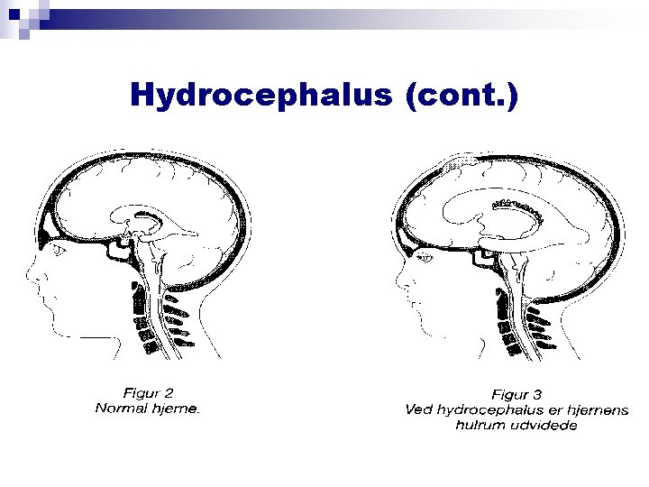 Hydrocephalus (cont. ) Hydrocephalus (cont. )