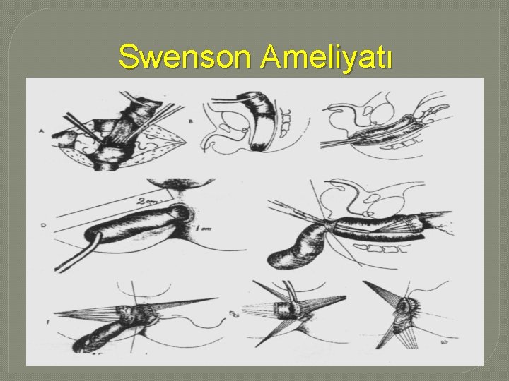 Swenson Ameliyatı Swenson Ameliyatı