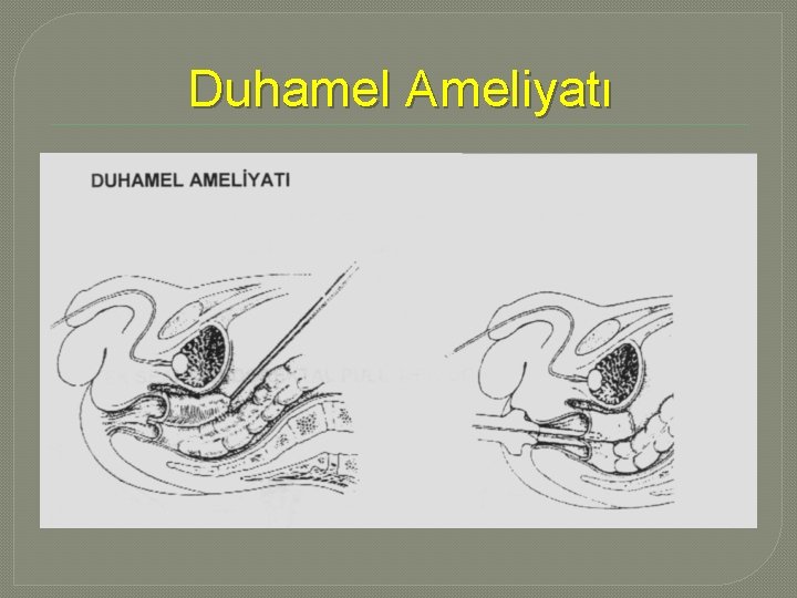 Duhamel Ameliyatı Duhamel Ameliyatı