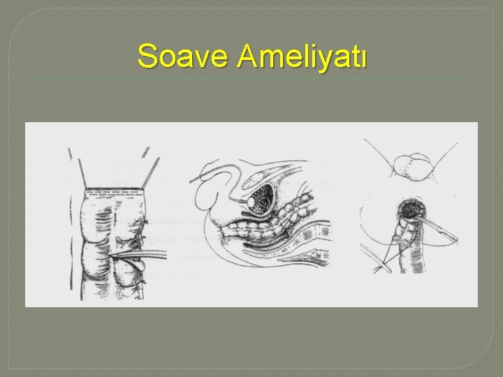 Soave Ameliyatı Soave Ameliyatı