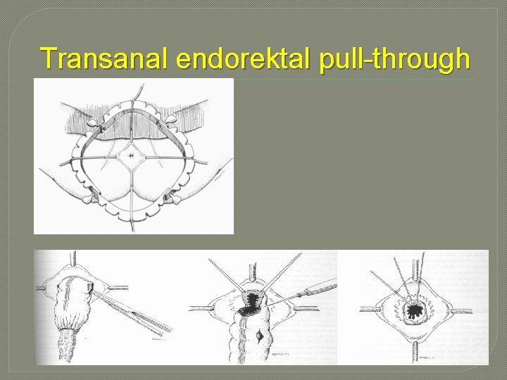 Transanal endorektal pull-through Transanal endorektal pull-through