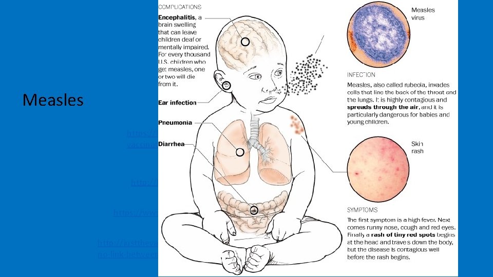 Measles https: //karenvaxblog. wordpress. com/2015/08/26/isvaccinating-a-private-choice/ http: //healthpsych. psy. vanderbilt. edu/2008/mmrautism. htm https: //www. ncbi.