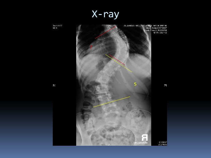 X-ray 7 5 X-ray 7 5