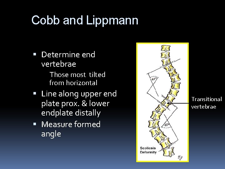 Cobb and Lippmann Determine end vertebrae Those most tilted from horizontal Line along upper Cobb and Lippmann Determine end vertebrae Those most tilted from horizontal Line along upper