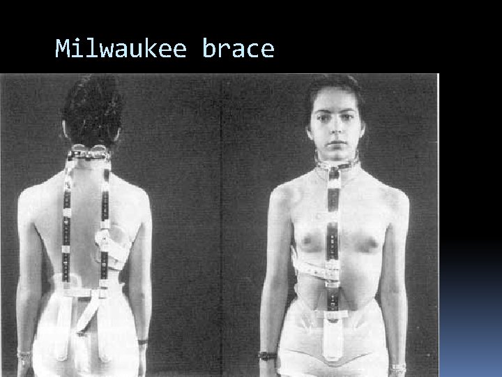 Milwaukee brace Milwaukee brace