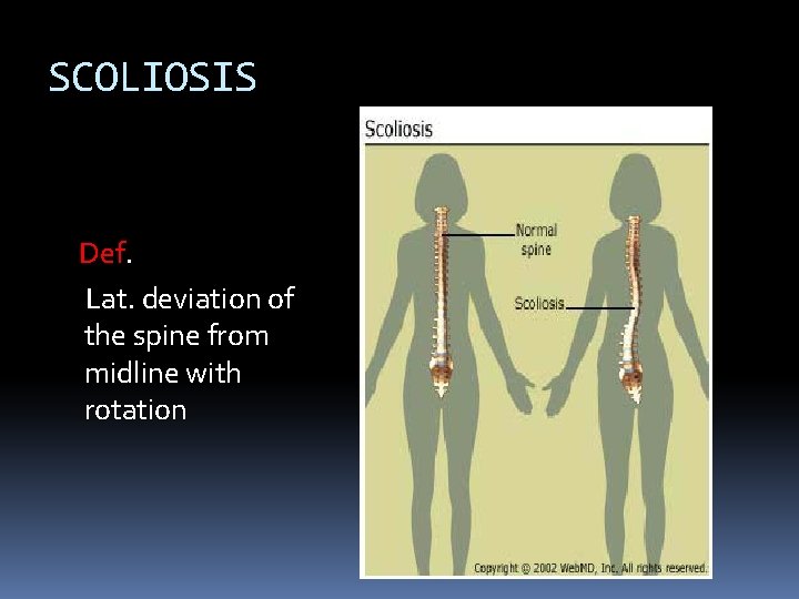 SCOLIOSIS Def. Lat. deviation of the spine from midline with rotation SCOLIOSIS Def. Lat. deviation of the spine from midline with rotation