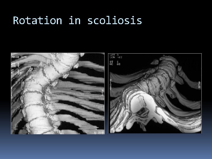 Rotation in scoliosis Rotation in scoliosis