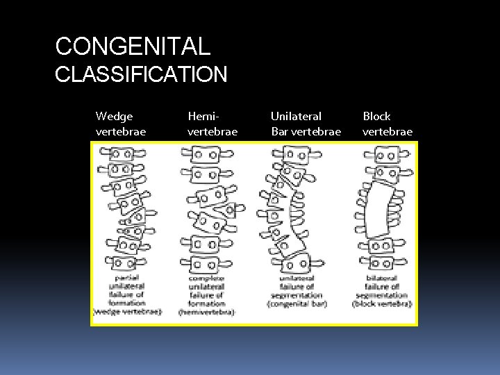 CONGENITAL CLASSIFICATION Wedge vertebrae Hemivertebrae Unilateral Bar vertebrae Block vertebrae CONGENITAL CLASSIFICATION Wedge vertebrae Hemivertebrae Unilateral Bar vertebrae Block vertebrae