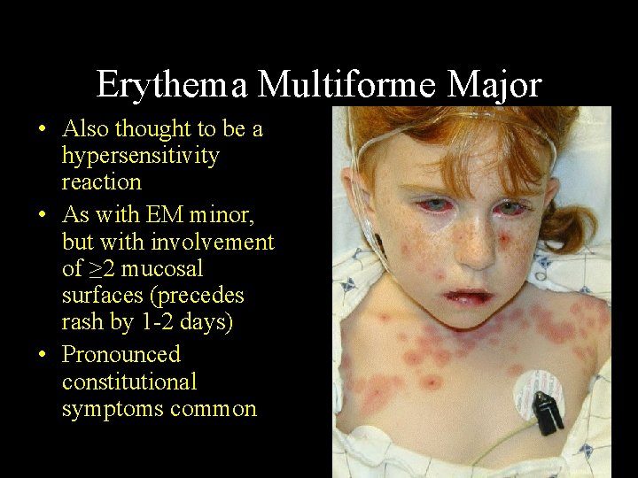 Erythema Multiforme Major • Also thought to be a hypersensitivity reaction • As with