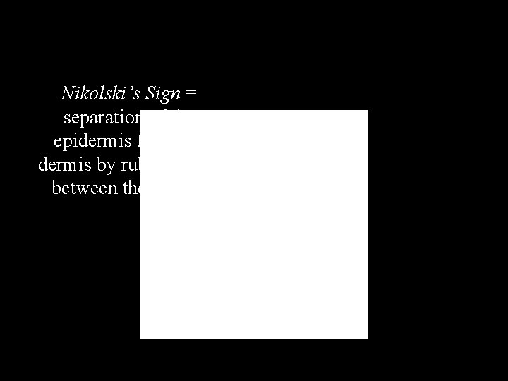 Nikolski’s Sign = separation of the epidermis from the dermis by rubbing skin between