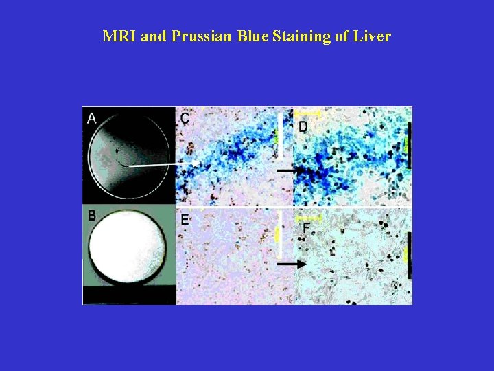 MRI and Prussian Blue Staining of Liver 