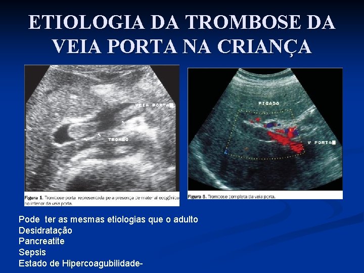 ETIOLOGIA DA TROMBOSE DA VEIA PORTA NA CRIANÇA Pode ter as mesmas etiologias que