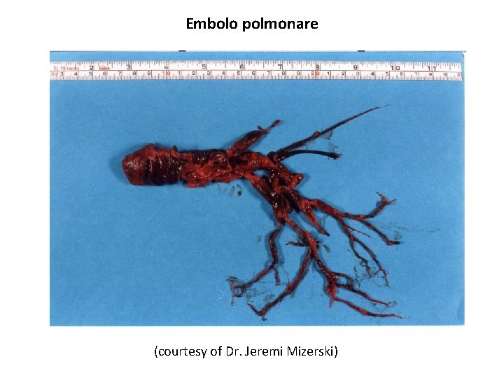 Embolo polmonare (courtesy of Dr. Jeremi Mizerski) 