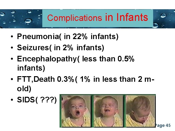Complications Powerpoint Templatesin Infants • Pneumonia( in 22% infants) • Seizures( in 2% infants)