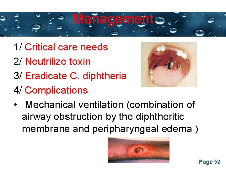Management Powerpoint Templates 1/ Critical care needs 2/ Neutrilize toxin 3/ Eradicate C. diphtheria