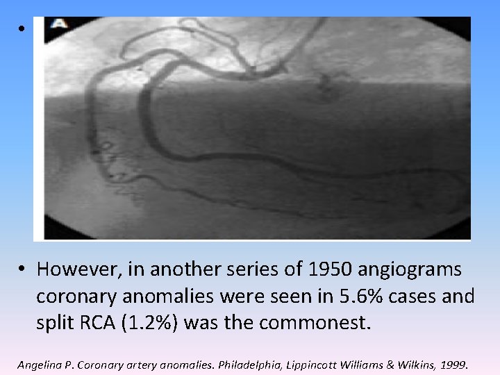  • The most common coronary variation (Cleveland Clinic-1, 26, 000 patients) was separate