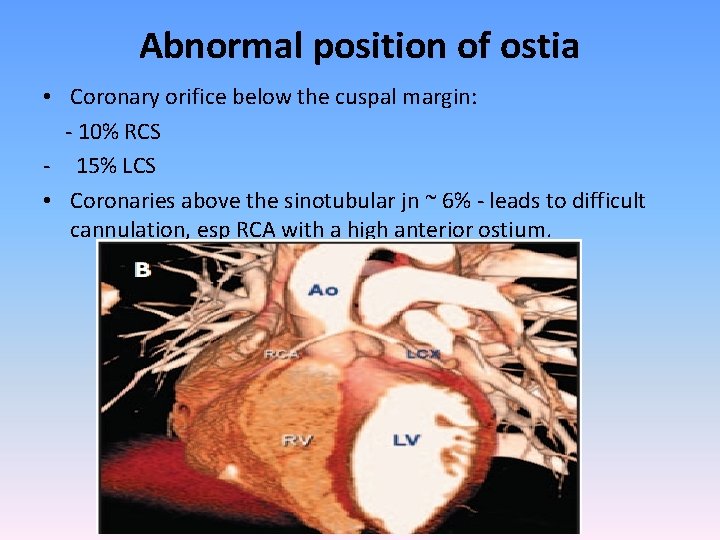 Abnormal position of ostia • Coronary orifice below the cuspal margin: - 10% RCS